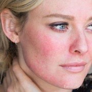 Yuk Pakai Skincare Khusus untuk Kulit Kemerahan Berikut, Ladies!