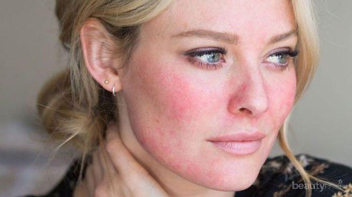 Yuk Pakai Skincare Khusus untuk Kulit Kemerahan Berikut, Ladies!