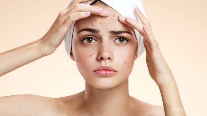 [FORUM] Tiba-tiba jerawatan padahal sabtu ada koondangan! Harus gimana nih?