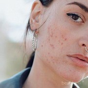 Lelah dengan Jerawat? Simak Tutorial Skincare Routine Untuk Kulit Berjerawat Ini!