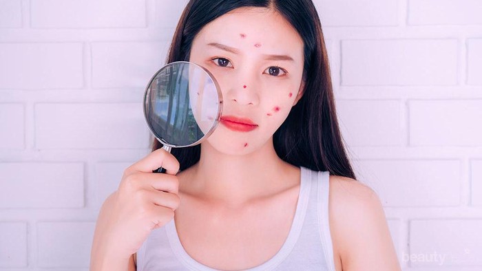 [FORUM] Jerawat Putsula dan Nodula? Bedanya apa sih guys?