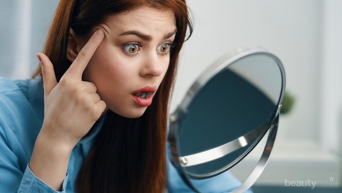 Tiba-Tiba Jerawat Muncul di Sekitar Garis Rambut? Segera Atasi dengan Cara Ini Yuk!