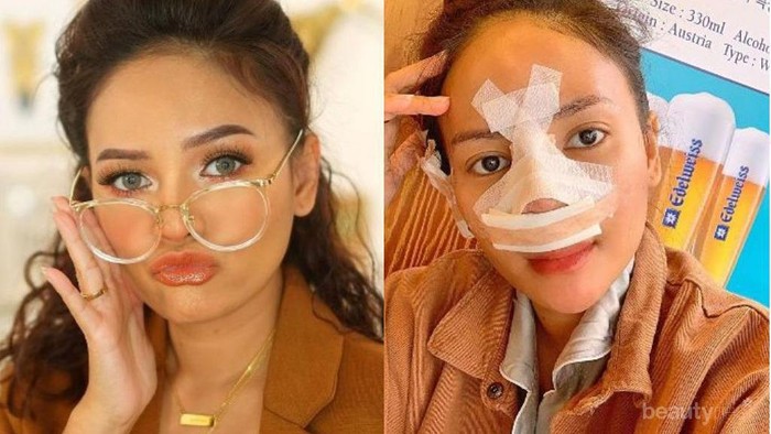 Cerita Rachel Goddard Operasi Hidung karena Flu Tak Kunjung Sembuh