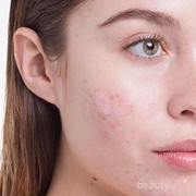 6 Cara Hilangkan Jerawat Batu dengan Bahan Alami, Ampuh Tanpa Meninggalkan Bekas!