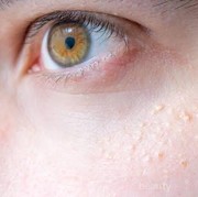 [FORUM] Help! Ada yang tahu sabun wajah untuk breakout?