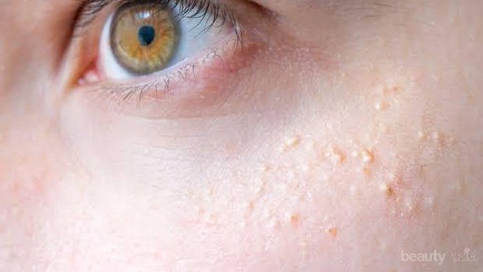 [FORUM] Help! Ada yang tahu sabun wajah untuk breakout?