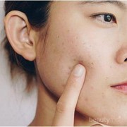 [FORUM] Minta rekomendasi obat buat ngilangin jerawat dong...