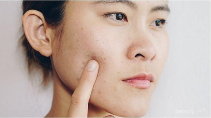 [FORUM] Minta rekomendasi obat buat ngilangin jerawat dong...