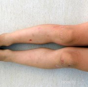 [FORUM] Cara menghilangkan bekas gigitan nyamuk gimana ya ladies?