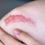 Mengenal Masalah Kulit Keloid, Cari Tahu Penyebab dan Cara Mengatasinya