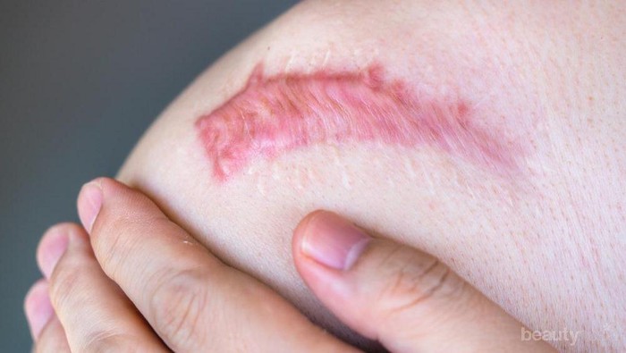 Mengenal Masalah Kulit Keloid, Cari Tahu Penyebab dan Cara Mengatasinya