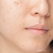 Tanpa Laser, Ini Langkah Pasti Pudarkan Noda Hitam Bekas Jerawat