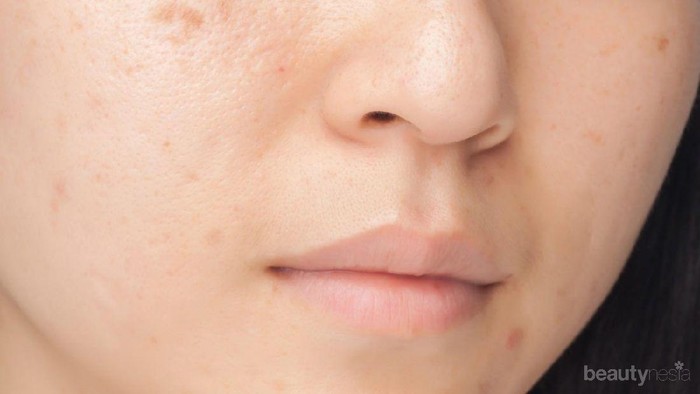 Tanpa Laser, Ini Langkah Pasti Pudarkan Noda Hitam Bekas Jerawat Tanpa Laser, Ini Langkah Pasti Pudarkan Noda Hitam Bekas Jerawat