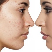 BB Glow Treatment Jadi Populer, Apakah Aman Dilakukan?
