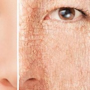 [FORUM] Share dong ladies, gimana sih cara ngatasin kulit kering karna kurang minum?