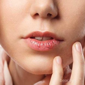 Bibir Pecah-pecah Tak Kunjung Reda, Mungkin Kamu Belum Lakukan 5 Hal Ini