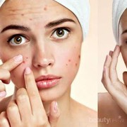 [FORUM] Cara Menghilangkan Bekas Jerawat yang Menghitam dong girlss!