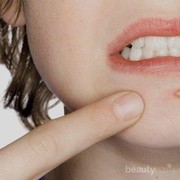 [FORUM] Minta tips agar tidak jerawatan pada saat menjelang datang bulan ya!