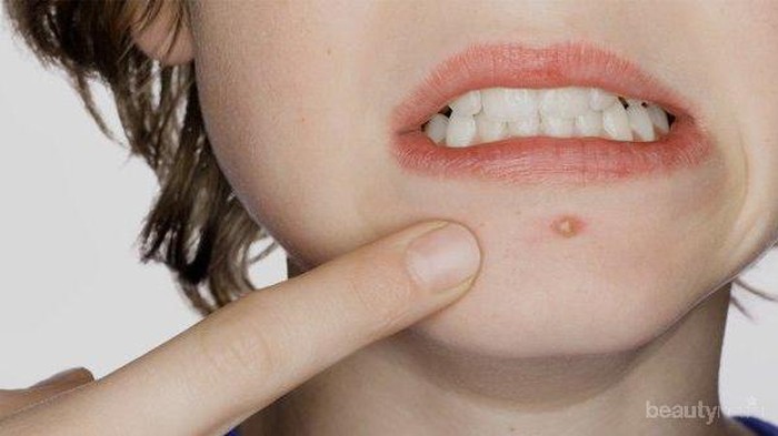 [FORUM] Minta tips agar tidak jerawatan pada saat menjelang datang bulan ya!