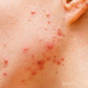 ada yang pernah ngalamin Jerawat kista atau Jerawat Hormonal ?