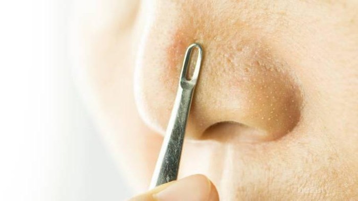 Jangan Dulu Panik, Begini Cara Menghilangkan Komedo Putih dan Hitam