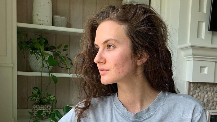 Jerawat Kemerahan Hilang Sekejap Pakai 5 Bahan Sepele Ini