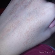 [FORUM] Ada yang Punya Freckles Hitam Di Tangan?