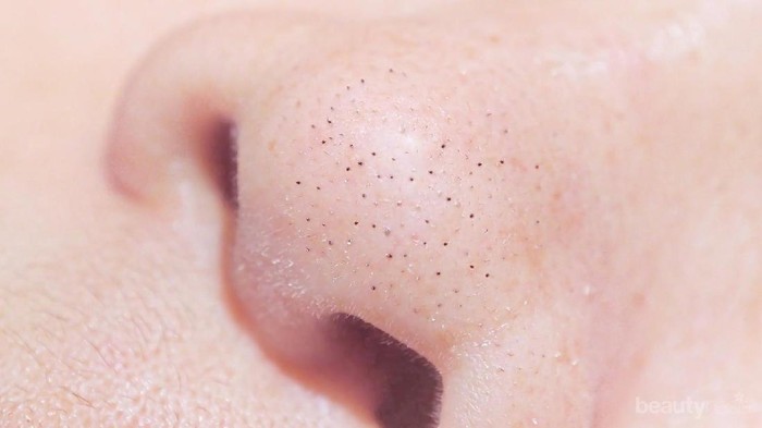 Tidak Perlu Facial di Salon, Cukup Lakukan 6 Langkah Mudah Ini untuk Hilangkan Komedo