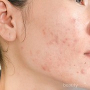 5 Cara Mudah Menghilangkan Jerawat Batu Membandel, Dijamin Ampuh!