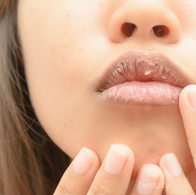 Hat-hati Bibir Kering Bisa Berdarah, Cari Tahu Penyebabnya untuk Segera Diatasi