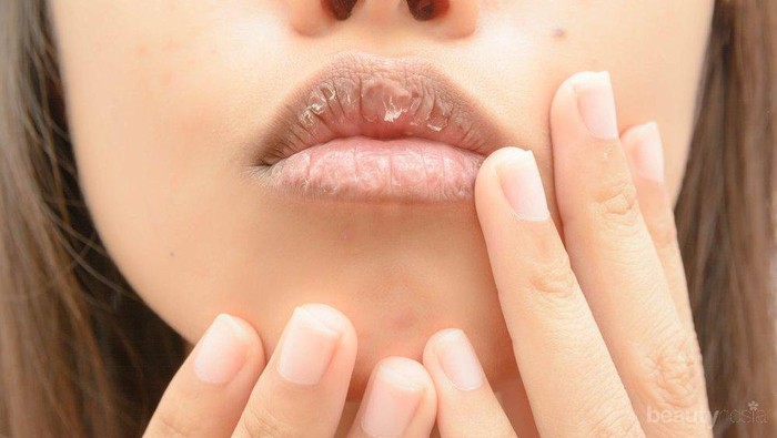 Hat-hati Bibir Kering Bisa Berdarah, Cari Tahu Penyebabnya untuk Segera Diatasi