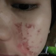 [FORUM] Kenapa muka memerah seperti luka bakar setelah memakai cuka apel?