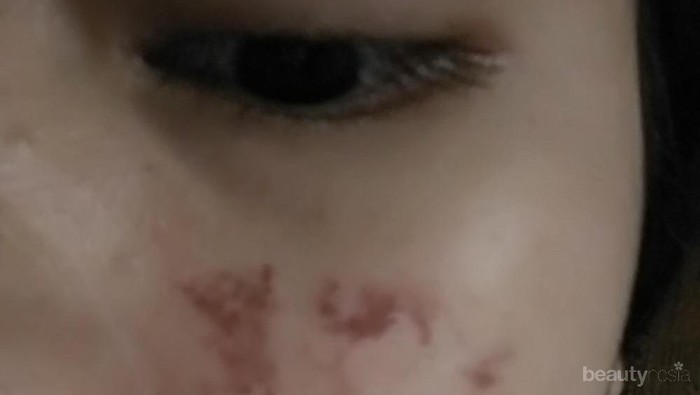 [FORUM] Kenapa muka memerah seperti luka bakar setelah memakai cuka apel?