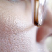 Penyebab Munculnya Blackheads dan Whiteheads Serta Cara Mengatasinya