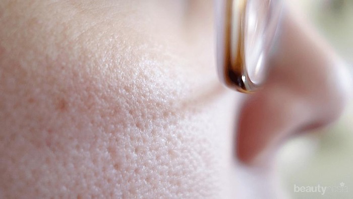 Penyebab Munculnya Blackheads dan Whiteheads Serta Cara Mengatasinya