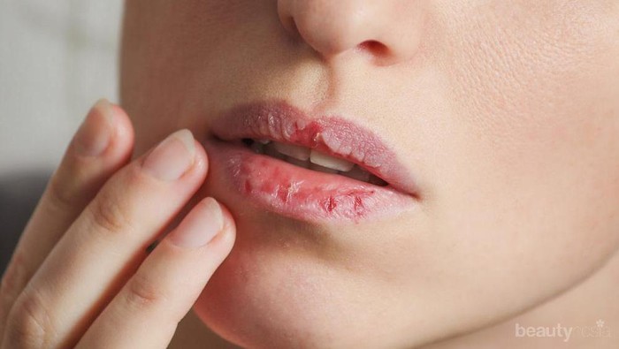 Bibir Kamu Kering? 5 Hal ini Mungkin Penyebabnya Ladies!