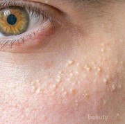 Beauty Tips: Cara Menghilangkan Milia, Bintik Putih di Bawah Mata Secara Efektif