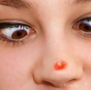 Cara Mengatasi Jerawat Mengganggu di Hidung