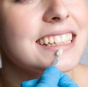 Veneer Putihkan Gigi Secara Instan, Lakukan 4 Tips Ini untuk Merawatnya