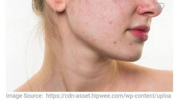 [FORUM] Saran pelembab atau cream whitening untuk kulit berminyak sensitif