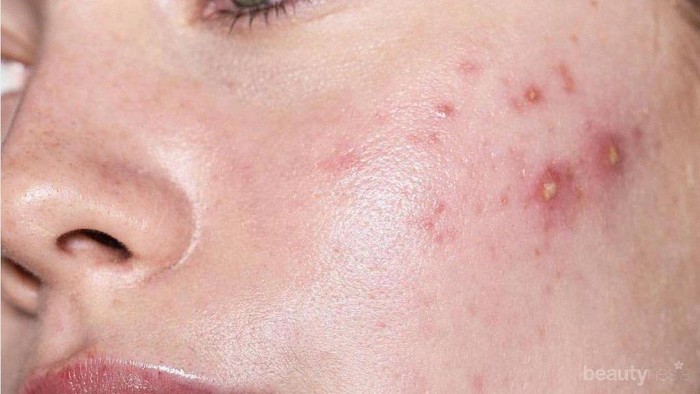 Jerawatan Parah? 4 Alasan Ini Buatmu Yakin untuk Perawatan di Dr Kun