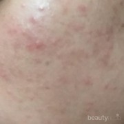 [FORUM] Ada rekomendasi Scrub st. Ives yang cocok untuk kulit sensitif dan berjerawat?