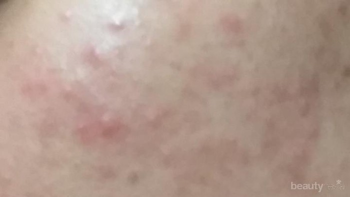 [FORUM] Ada rekomendasi Scrub st. Ives yang cocok untuk kulit sensitif dan berjerawat?