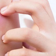 [FORUM] Cara ngilangin bekas gigitan nyamuk gimana sih sist,,