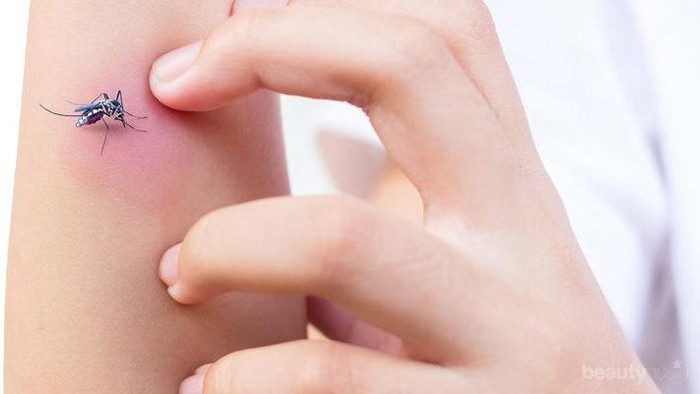 [FORUM] Cara ngilangin bekas gigitan nyamuk gimana sih sist,,