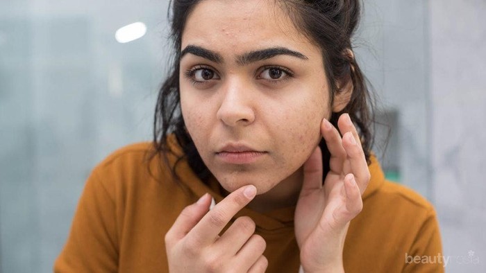 Jerawat di Dagu Tandanya Apa ya? Cari Tahu yuk!