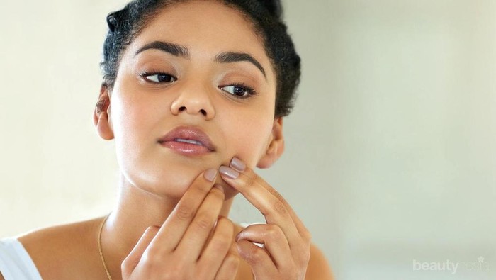 4 Acne Patch Ini Buatmu Ucapkan Selamat Tinggal Pada Jerawat dalam Semalam
