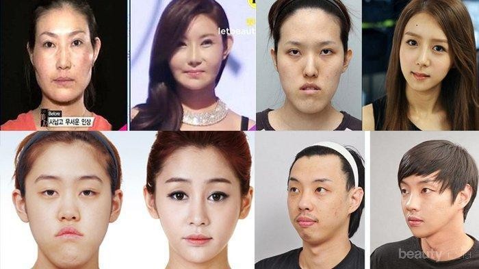 9 Operasi Plastik Paling Populer di Korea Selatan, Tertarik Coba?