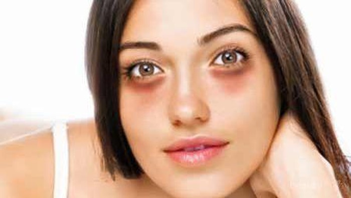 Sering Begadang? 5 Bahan Alami Ini Ampuh Samarkan Mata Panda