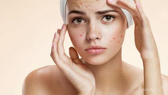 Wajib Tahu, 13 Penyebab Munculnya Jerawat dan Cara Mengatasinya